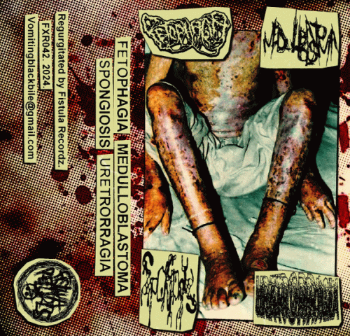 Fetophagia : Fetophagia - Spongiosis - Medulloblastoma - Uretrorrhagia